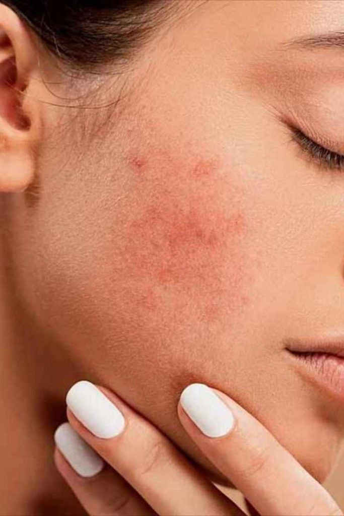 acne protocol care